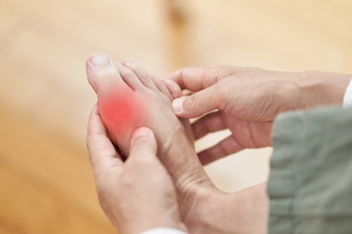 How is Gout treated?