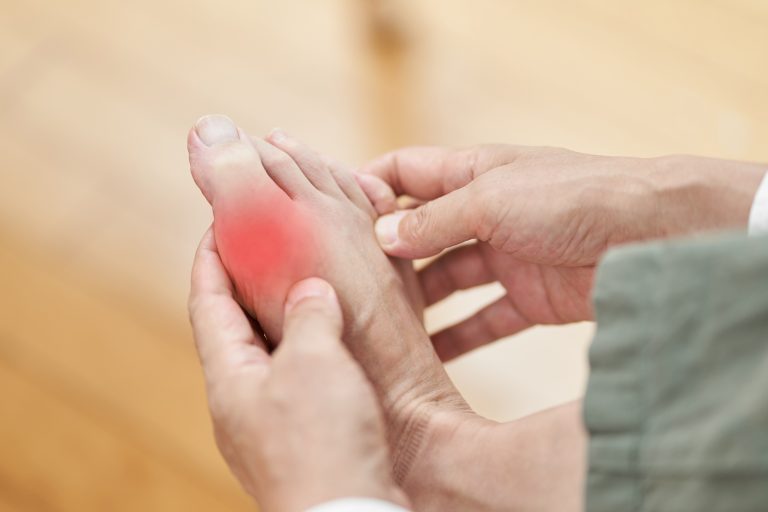 How is Gout treated?